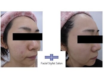 フェイシャルスタイリストサロン 四谷店/ケア例(22)