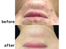 サージュクロレ 松戸店(sage colorer)/クリスタルハーブピーリング