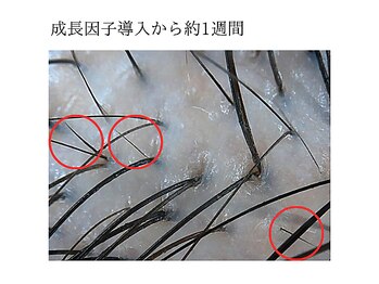 スカルプラボ(Scalp Lab)/M様新毛チェック