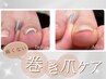 巻き爪ケア【親指1本】