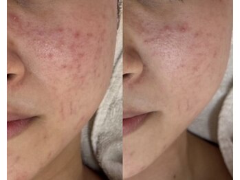 ミュー 自由が丘店(mieux)/◆肌質改善例