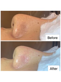 癒える(ielu)/【毛穴エクストラクション】B/A