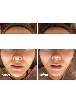 ミモザ 佐野(mimosa)/20代もっと小顔に