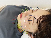 オリナ(olina)/人気NO.1美容鍼灸