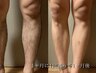 【初回男性】1回でも減ったと分かる全身ヒゲ込脱毛（VIO無し）¥11,800