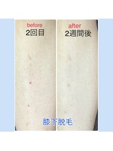 ミアローザ(Mia Rosa)/部分脱毛