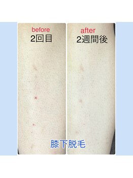 ミアローザ(Mia Rosa)/部分脱毛