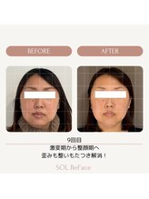 ソルビーフェイス(SOL*BeFace)/☆定着するまで☆