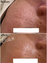 モンクラッシー(Mon classy)/ビオフィート毛穴改善