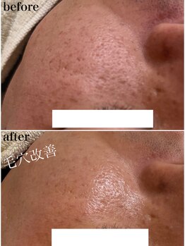 モンクラッシー(Mon classy)/ビオフィート毛穴改善