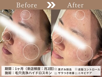 ファッショニスタ 恵比寿東口(Fashionista)/ハイドロ毛穴洗浄/毛穴改善