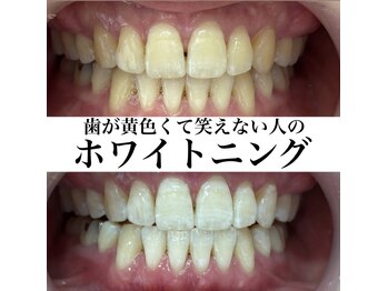 ヤット 森ノ宮(yatto.)の写真/歯科衛生士による施術で、歯本来の憧れの白さに導きます♪お悩みお気軽にご相談ください！
