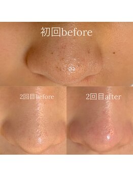 ウエカ(ueka)/隠す毛穴から魅せる毛穴に