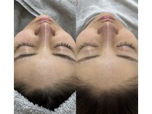 アイアール(ir)/施術前←　→ララピール2回目