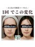 小顔矯正＋美肌美顔器＋オイル¥16,500→¥11,000【たるみ /シワ /肌質改善 】