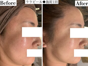 フレイヤ(FREYA)/ララピールBefore→After