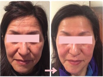 アブソリュートワン(absolute1)の写真/レチノール進化版!毛穴レスな艶玉美肌・圧縮小顔で二重アゴもスッキリ☆肌質改善と理想の肌が叶う究極ケア