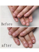 ティアラネイル 宇都宮/深爪矯正