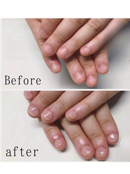 ティアラネイル 宇都宮/深爪矯正