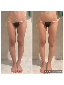 エクラ(Eclat)/Eclatの痩身★BeforeAfter13