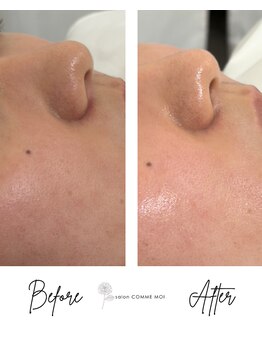 サロン コムモア(salon COMME MOI)の写真/お肌が弱い方でも選べる毛穴ケアでつるんとなめらか肌へ☆自信あふれる毎日を!