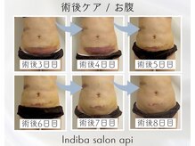 アピ(api)/症例写真【インディバ】