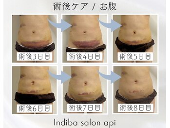 アピ(api)/症例写真【インディバ】