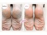ガザガザ解消☆削らないかかとケア（カ－ボキシ－21万ppm使用）30分 ￥3300