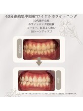 プラスビーセルフ(+b self)/ホワイトニングビフォーアフター