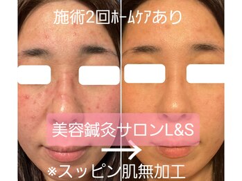 エルアンドエス(L&S)/ア○ピー肌・ニキビケア！