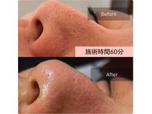 リノリー(rinory)/毛穴レスに♪