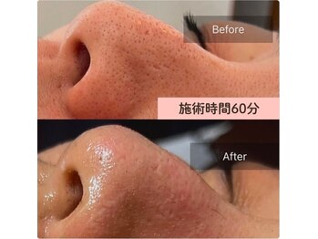リノリー(rinory)/毛穴レスに♪