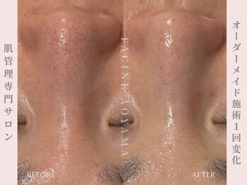 ファシネアオヤマ(FACINE AOYAMA)/毛穴洗浄一回での効果♪