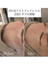 グランドシャルムエス(Grand Charme S)/最新IPL光フォト導入しました！