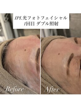 グランドシャルムエス(Grand Charme S)/最新IPL光フォト導入しました!