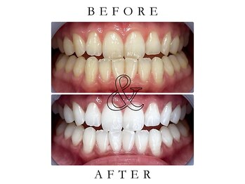 ジュエルホワイトニング/ホワイトニングビフォーアフター