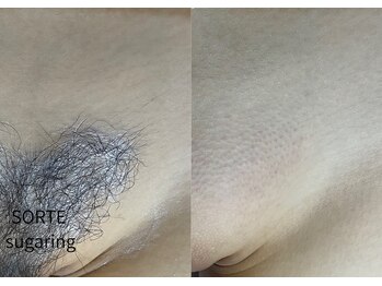 ソルテシュガーリング(SORTE sugaring)/シュガーリング