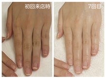 キレイテ 福岡天神店/関節の黒ずみ・くすみの悩み