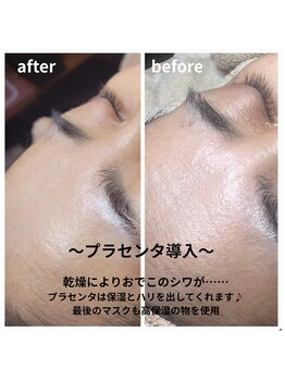 サロン ザ プマロ(SalonThePumalo)/プラセンタ導入/エイジングケア