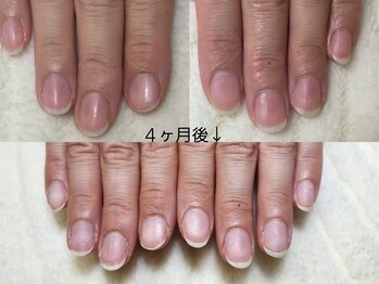 グラシナ なんば店/深爪/自爪育成/フィルイン