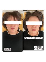 ラブリエ(LaBriller)/フェスラインもスッキリ