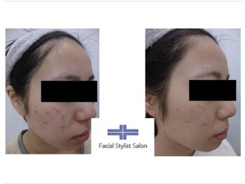 フェイシャルスタイリストサロン 四谷店/ケア例(23)