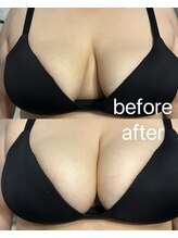 ビウラ(BIURA)/【30代】離れ乳改善