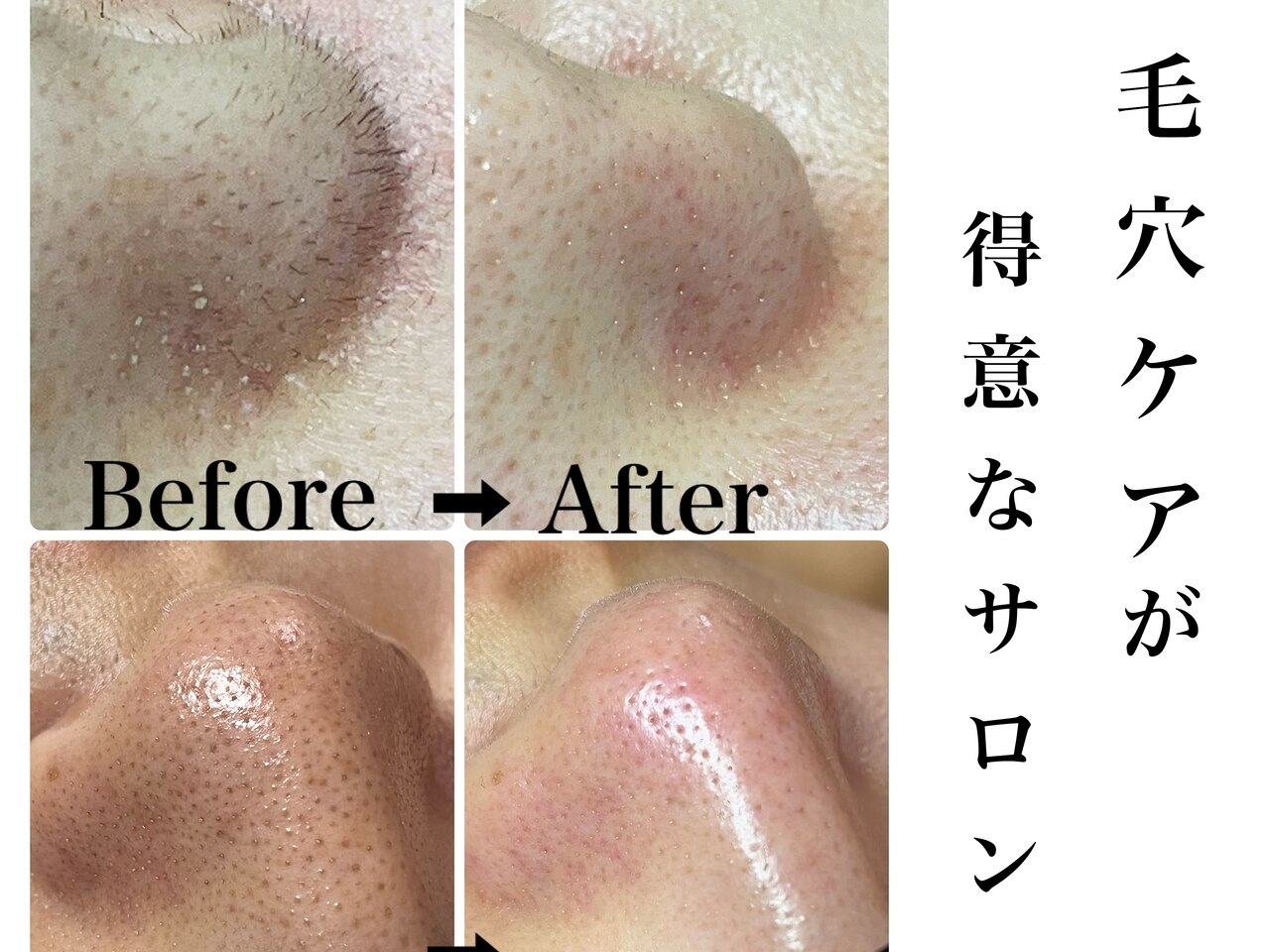 ハイドラフェイシャル 安い 京都に関するエステサロン 【美肌 ハイドラフェイシャル 安い 京都に関するエステサロン 【美肌