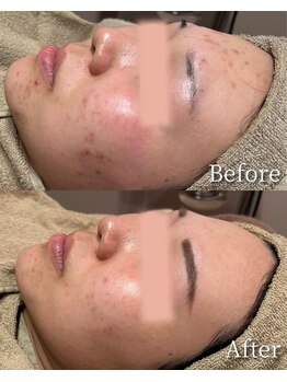 アンドエルビオ(&Elbio)/乳酸・グリコール酸Wピーリング