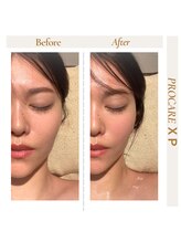 リ ラメール(Re.lamer)/機械フェイシャルBefore→After