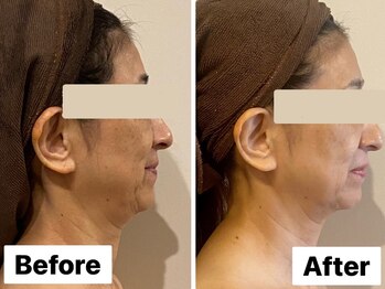 イオム ビューティワーク(IOM BEAUTY WORK)/リフトアップで若見え!