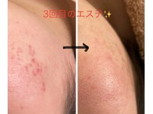 お客様が肌変化も、感じられたようで嬉しかったです♪