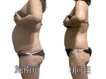 エリクシア 松戸/40代ウエスト集中痩身９回目