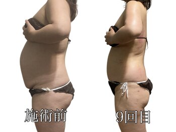 エリクシア 松戸/40代ウエスト集中痩身９回目